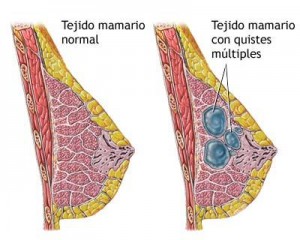 QUISTE[1]