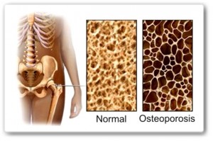 Osteoporosis-una-enfermedad-silenciosa-1187306