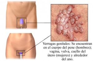 tratamiento-de-verrugas-genitales