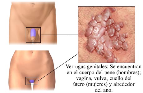 Oral steroids for acne treatment