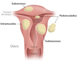 miomatosis