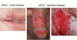 Genital-Herpes-HV1-e1423608033412
